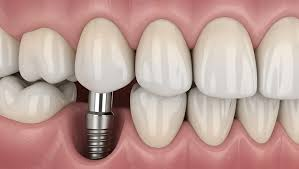 Advanced Dental Implants: Restoring Function with Expert Dentistry
